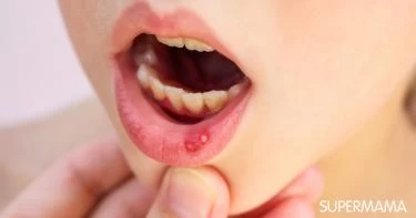 أعراض مرض بهجت عند الأطفال 